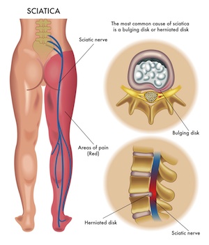 Sciatica