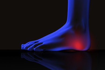 Painful heel due to plantar fasciitis